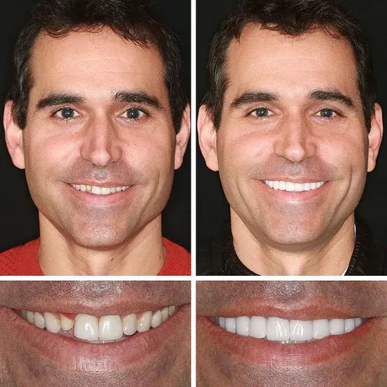 ⏰Ends Today: 50% OFF!  Custom-Fit — Designed for Comfort and a Natural-Looking Smile